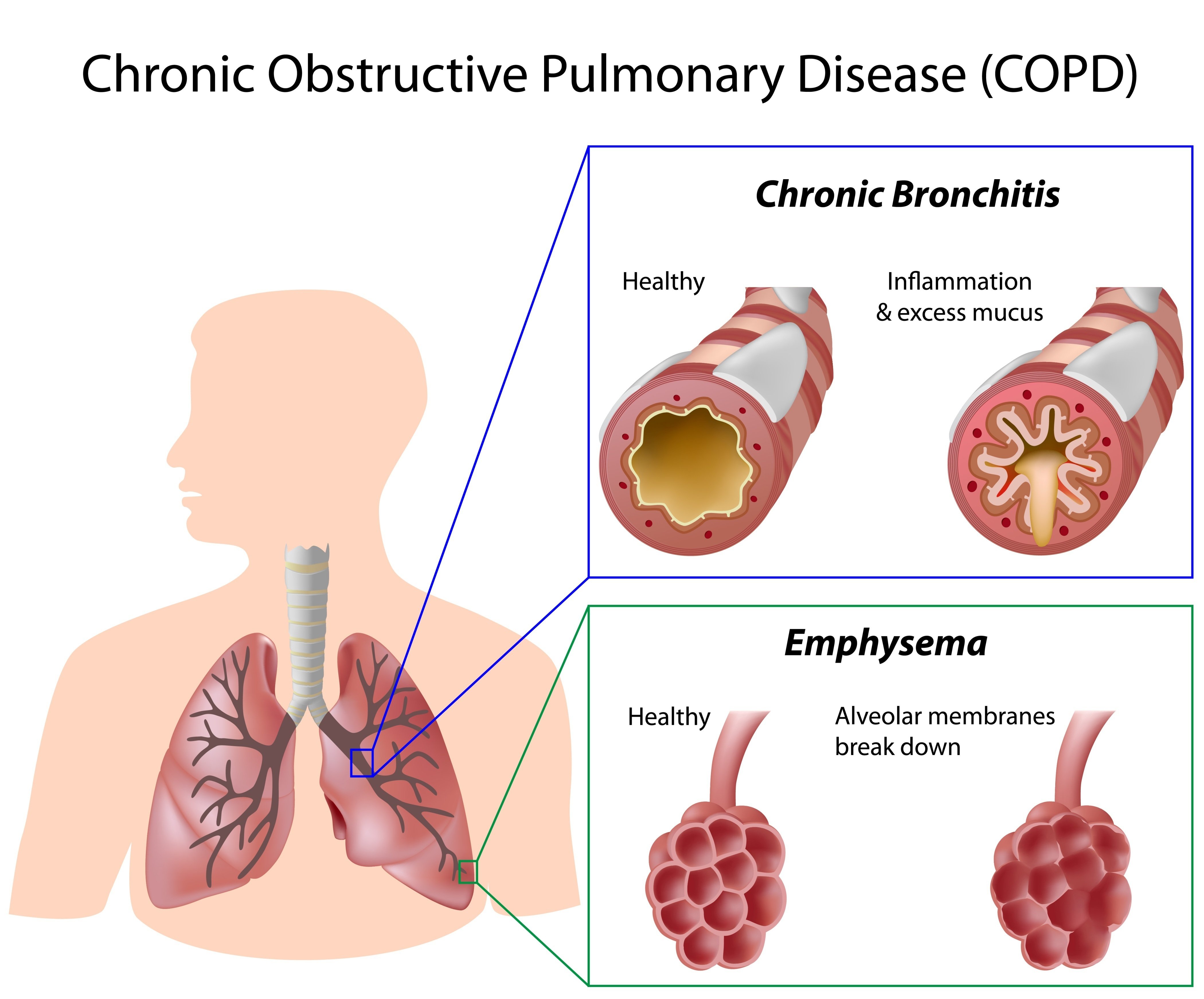 COPD