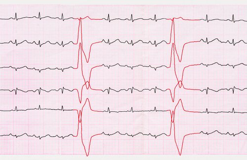 arrhythmia