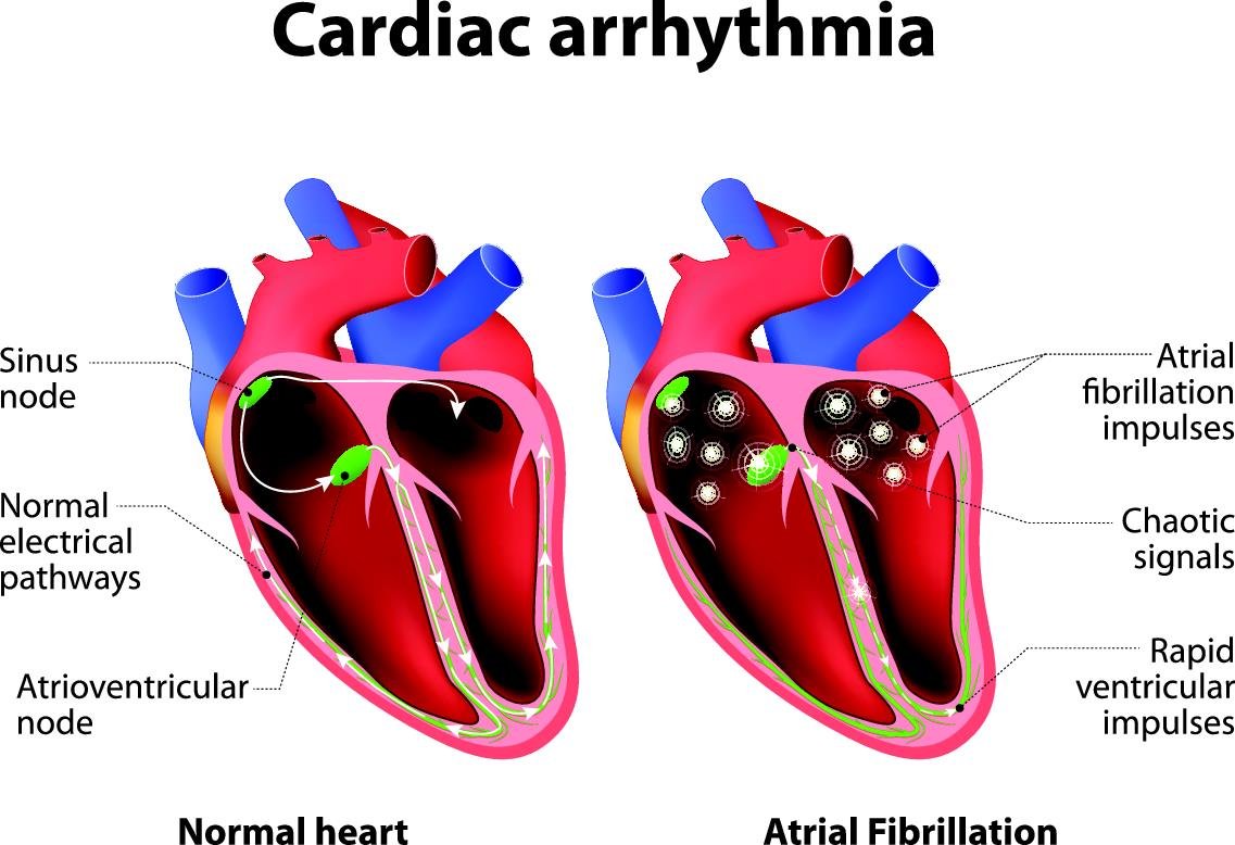 arrhythmia(2)