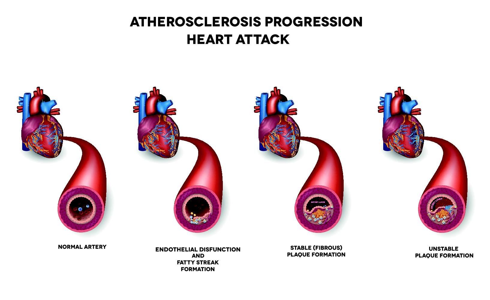 atherosclerosis progression