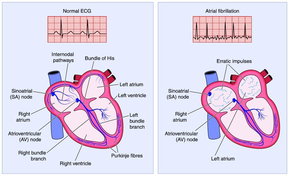 atrial fibrillation(2)