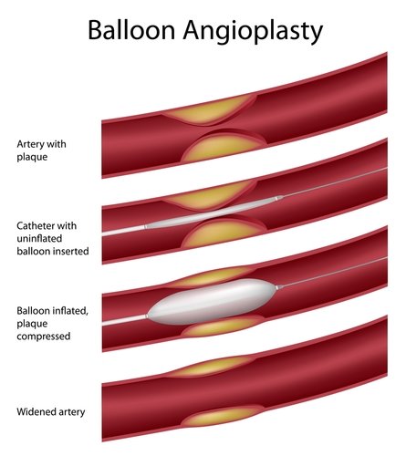 balloon angioplasty