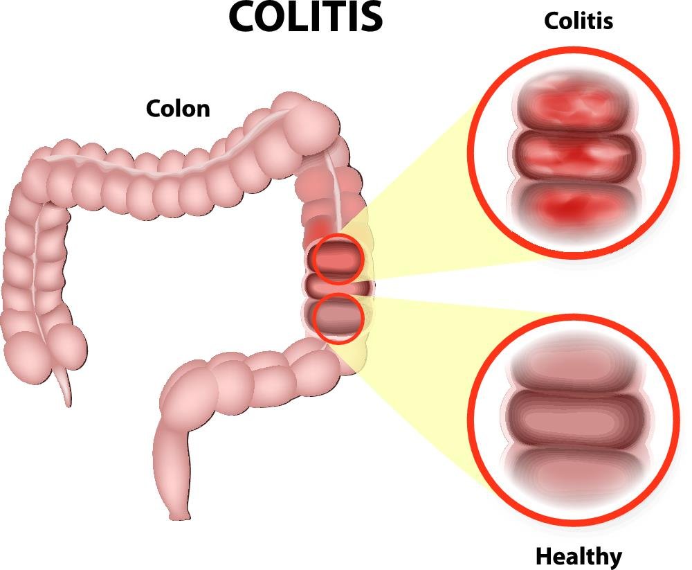 colitis
