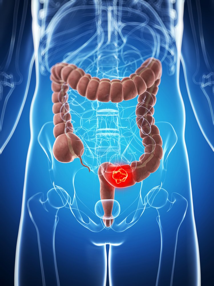 colorectal cancer anatomy