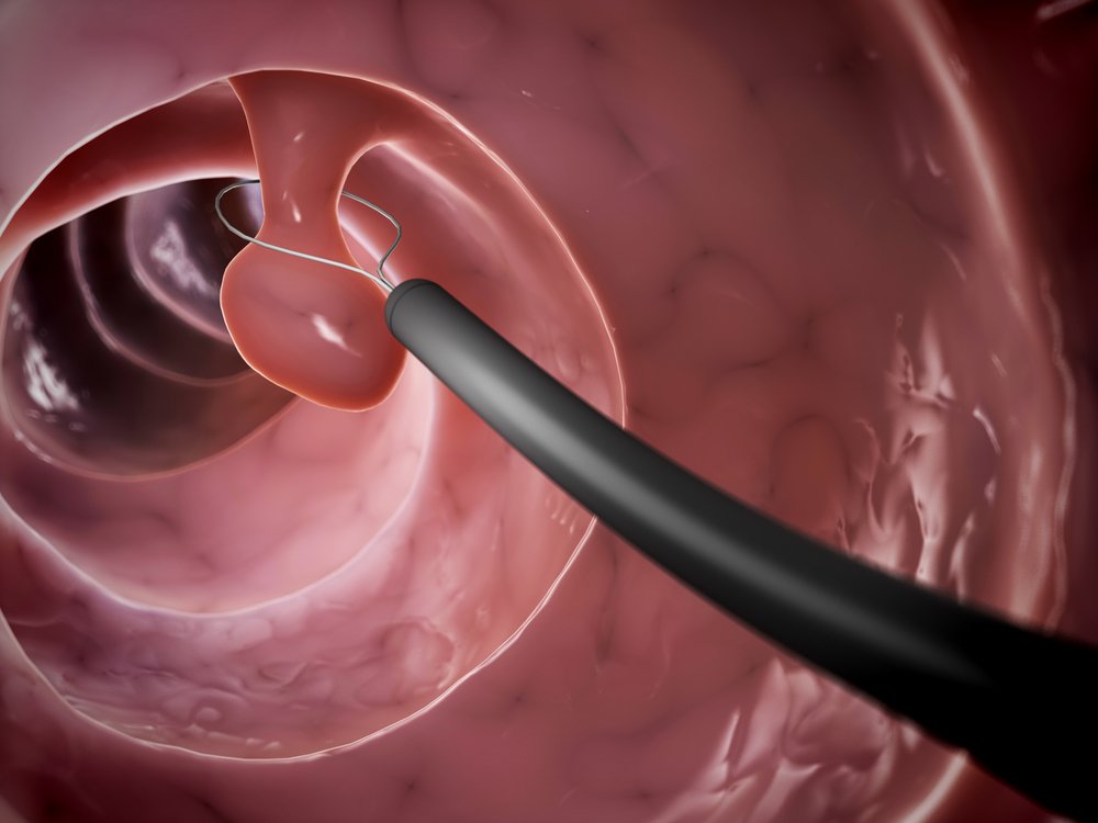 colorectal cancer colonoscopy