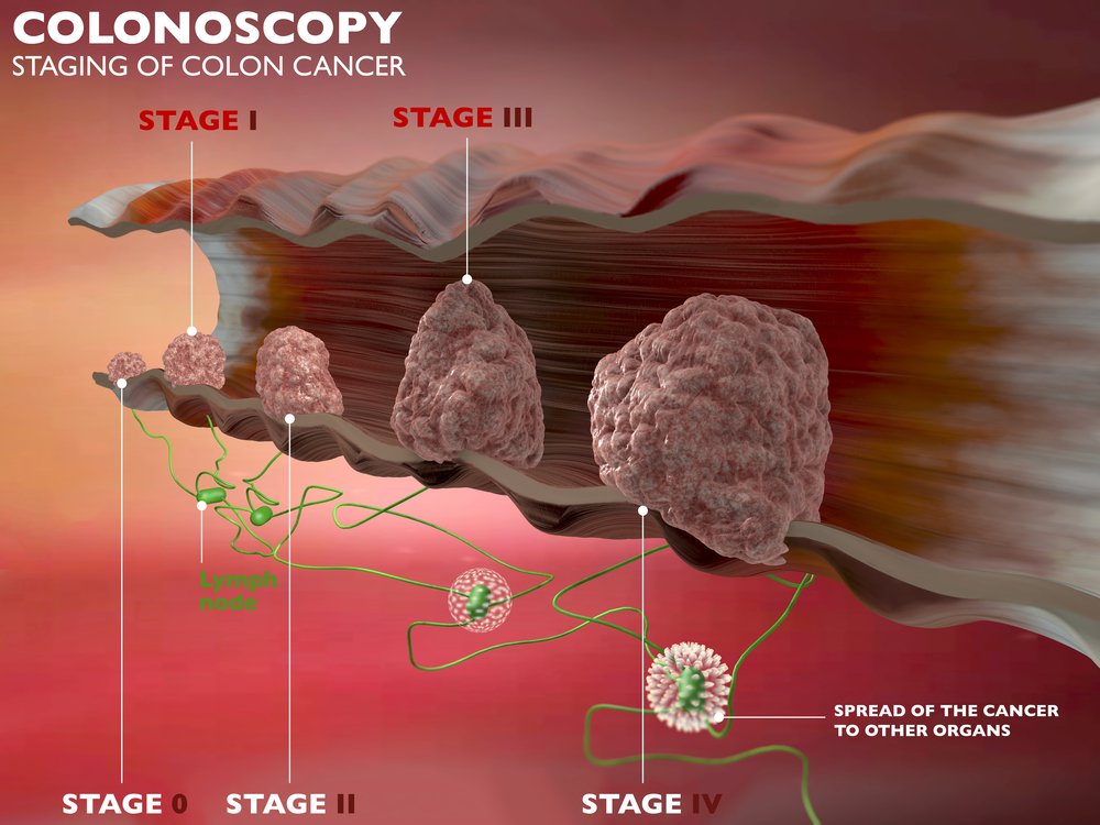 colorectal cancer stages